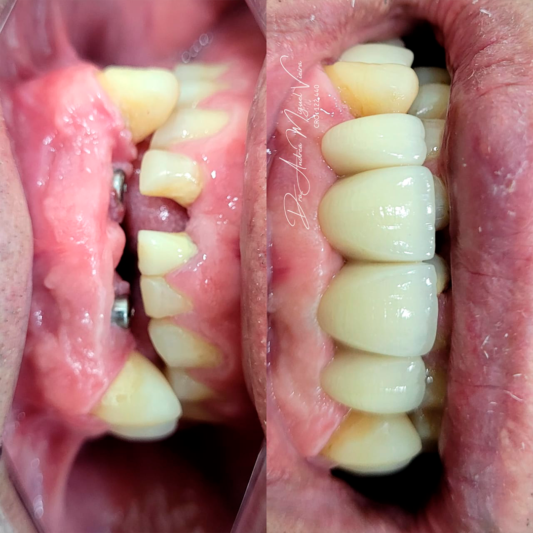 Transformação de sorriso - antes e depois