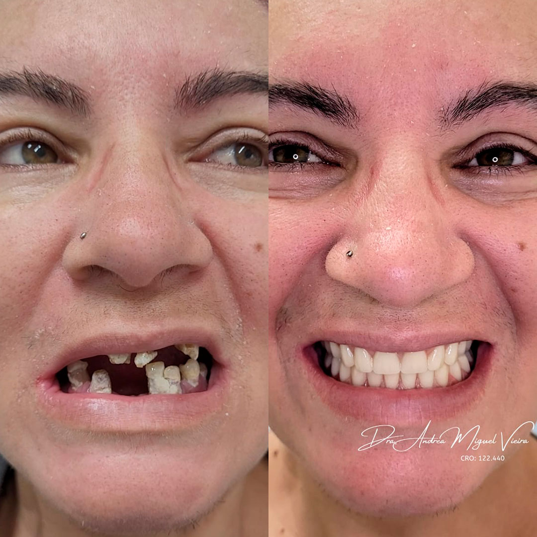Transformação de sorriso - antes e depois